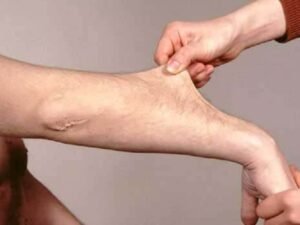 Ehlers-Danlos syndrome